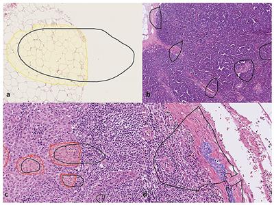 Deep learning model shows pathologist-level detection of sentinel node metastasis of melanoma and intra-nodal nevi on whole slide images